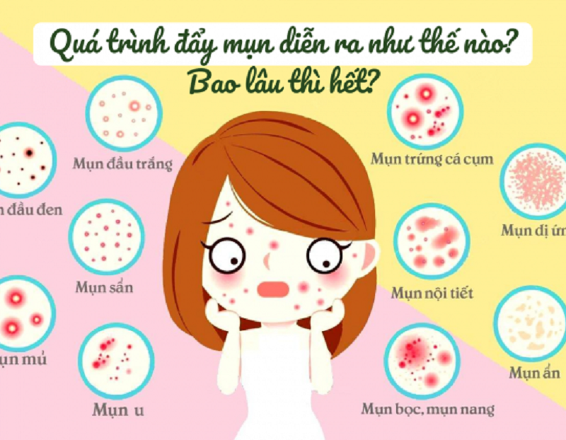 qua-trinh-day-mun-dien-ra-nhu-the-nao-bao-lau-thi-het-3